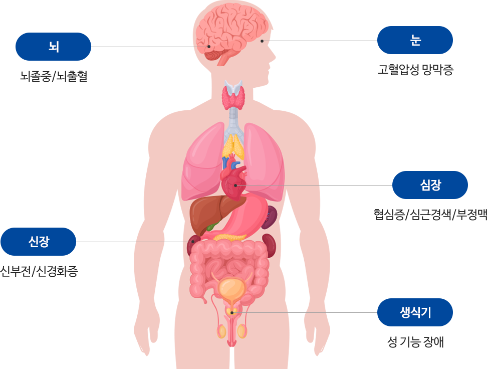 뇌 - 뇌졸중/뇌출혈, 눈 - 고혈압성 망막증, 심장 - 협심증/심근경색/부정맥, 신장 - 신부전/신경화증, 생식기 - 성 기능 장애